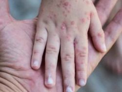 Dinkes Ajak Warga Lakukan Pencegahan Penularan Monkeypox